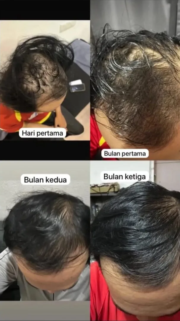 Four photos of a customer's head, labelled day one, month one, month two and month three